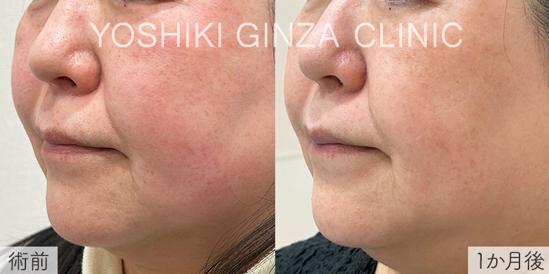 ミラノリピールの症例写真