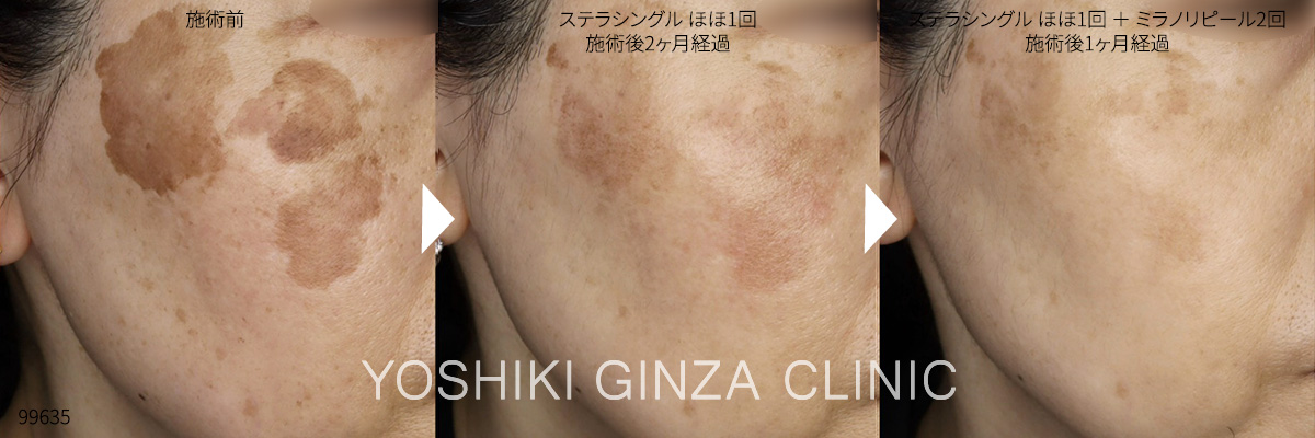 ミラノリピール+ステラシングルの症例写真