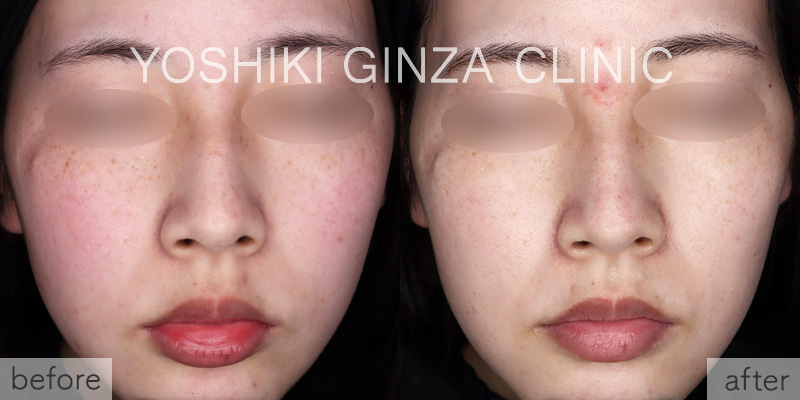 フォトフェイシャルほほ×3回の症例写真