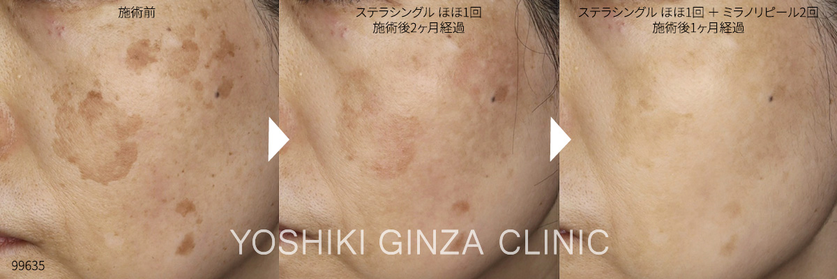ステラシングル+ミラノリピールの症例写真