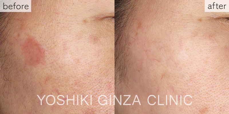 スーパーフォトセラピー（MaxG）全顔の症例写真