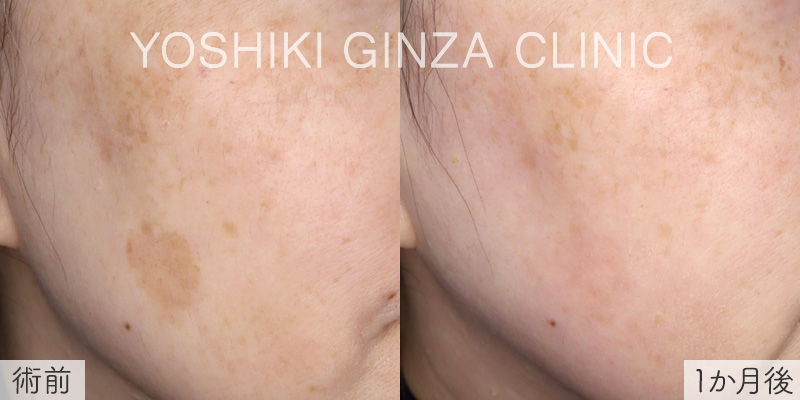 ピコスポットの症例写真