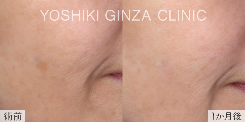 ピコスポットの症例写真