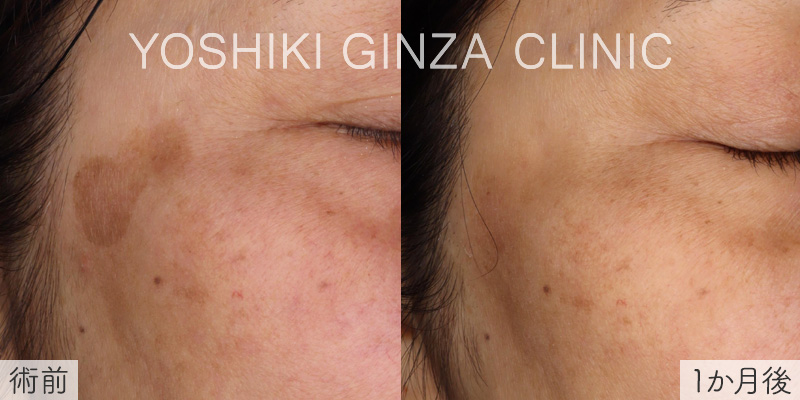 ピコスポットの症例写真