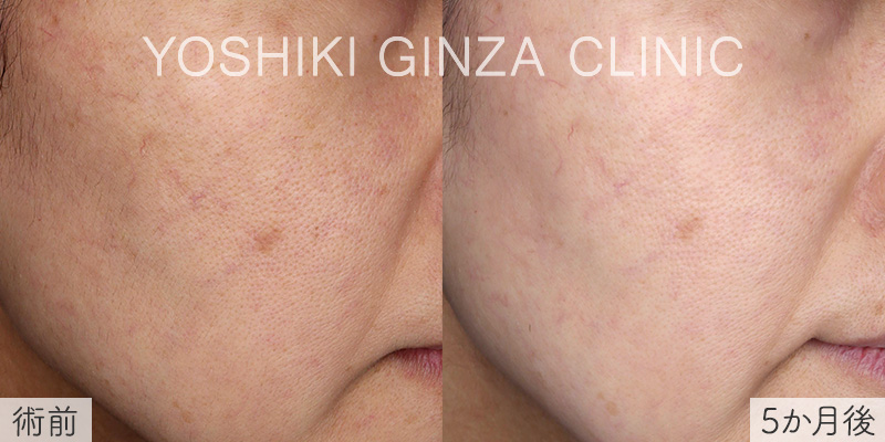 ピコトーニング×4回の症例写真