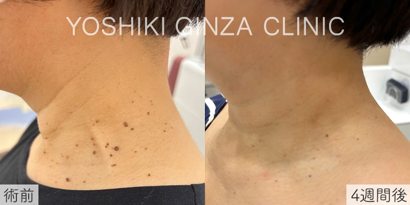 ピコスポット＋一部切除の症例写真