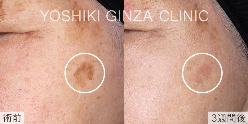 ピコスポットの症例写真