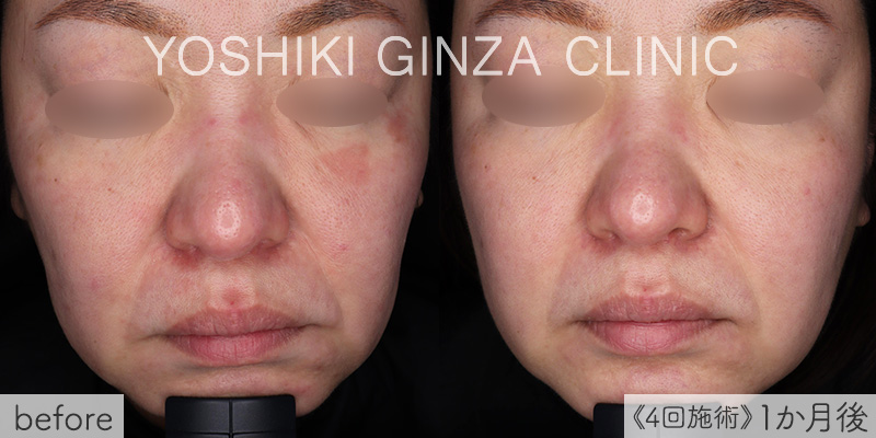 ピコトーニングの症例写真