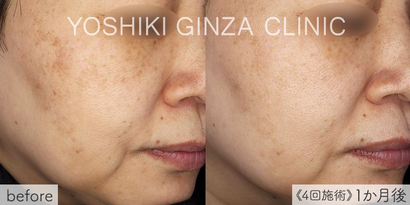 ピコトーニングの症例写真