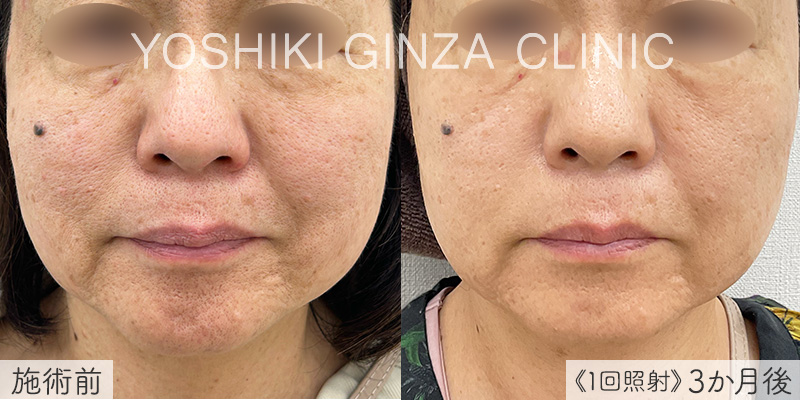 ピコフラクショナルの症例写真