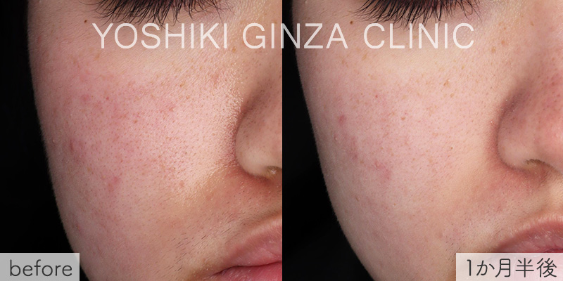 ピコトーニングの症例写真