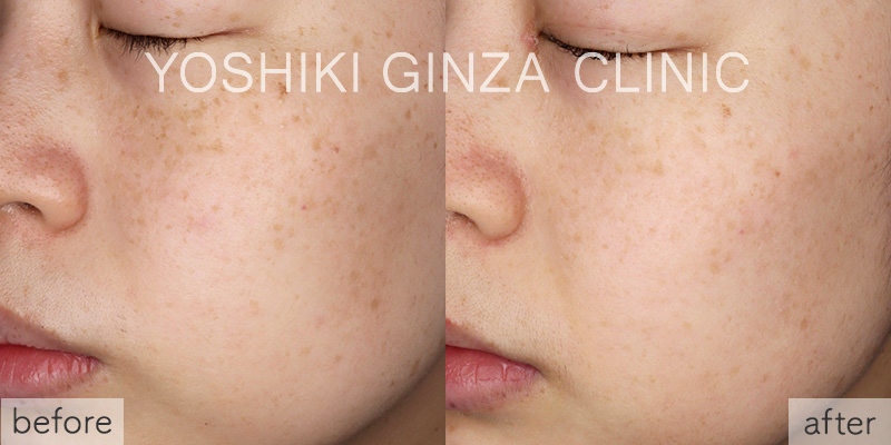 ピコスポットの症例写真