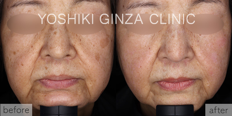 ピコスポット取り放題の症例写真