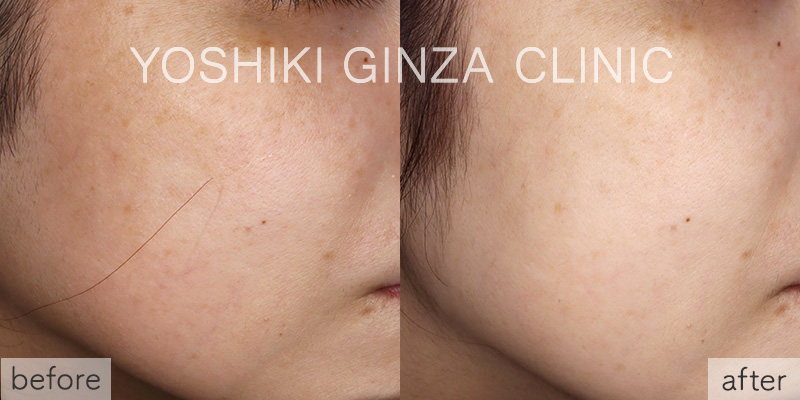 ピコトーニングの症例写真