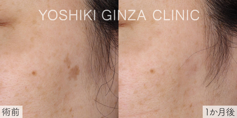 シミ取りレーザーの症例写真