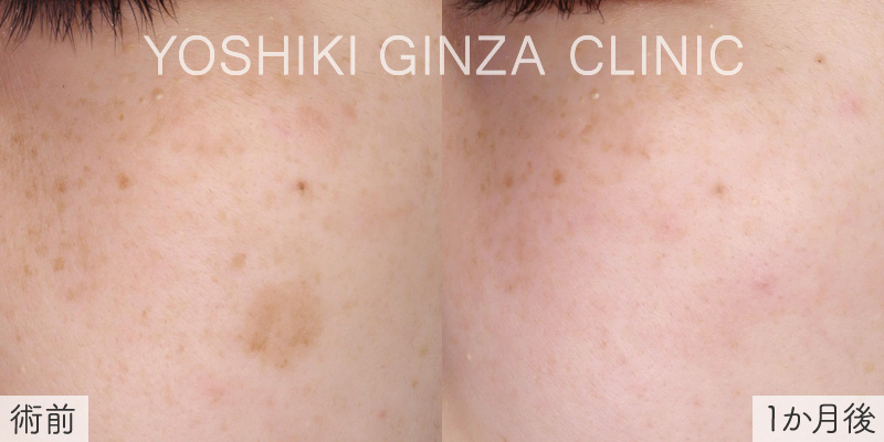 シミ取りレーザーの症例写真