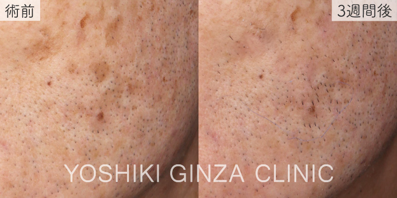 シミ取りレーザーの症例写真