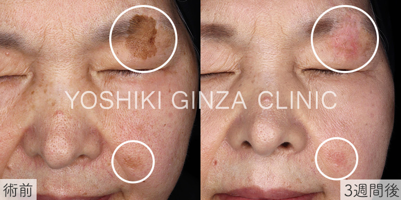 シミ取りレーザーの症例写真