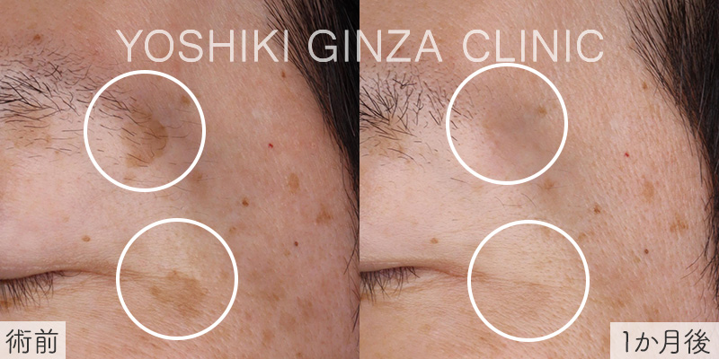 シミ取りレーザーの症例写真