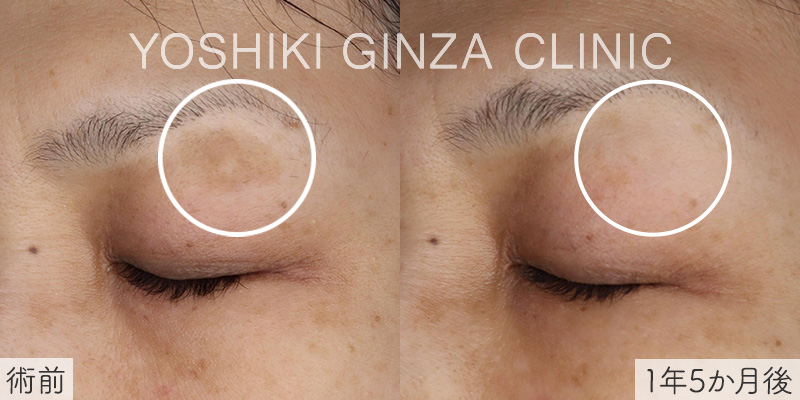 シミ取りレーザーの症例写真