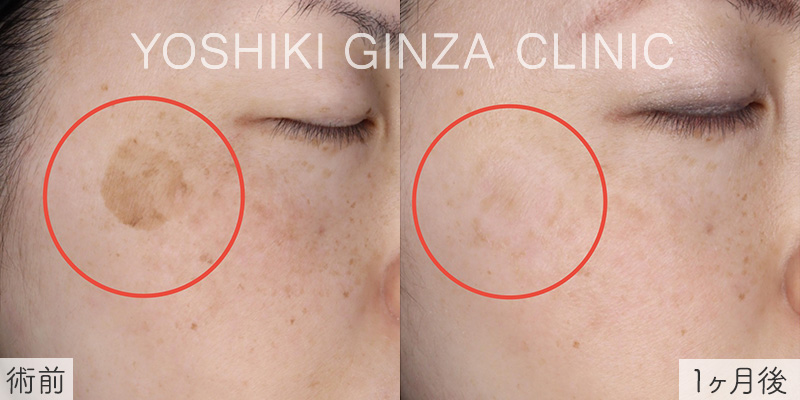 シミ取りレーザーの症例写真