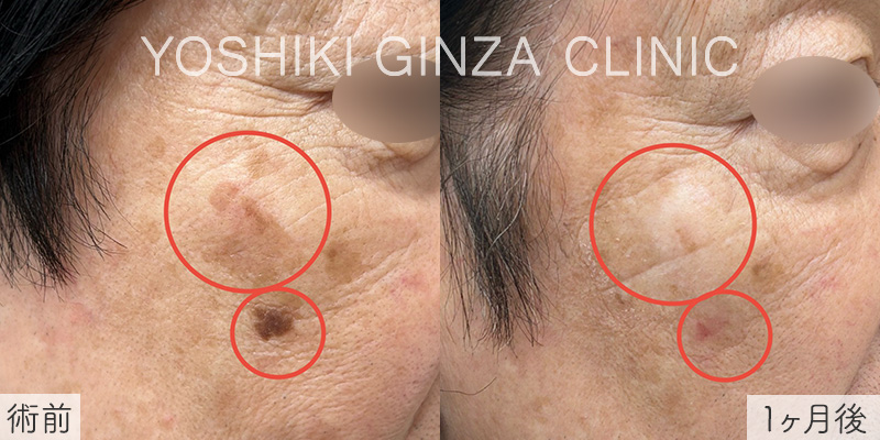 シミ取りレーザーの症例写真