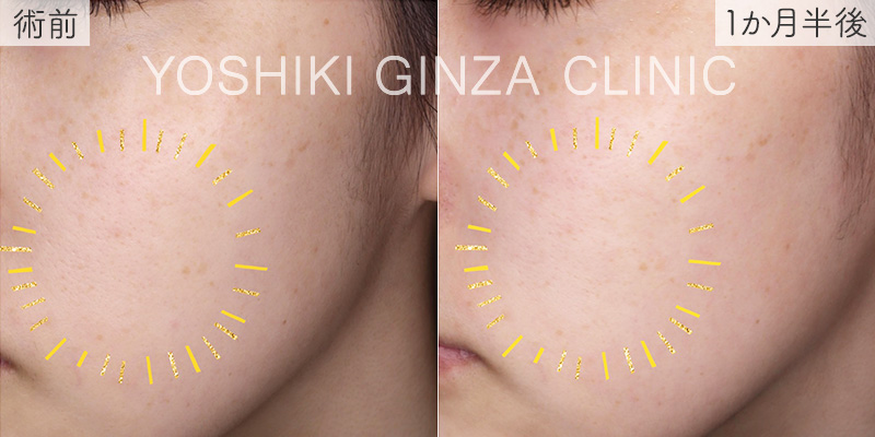 スキンボトックス ほほの症例写真