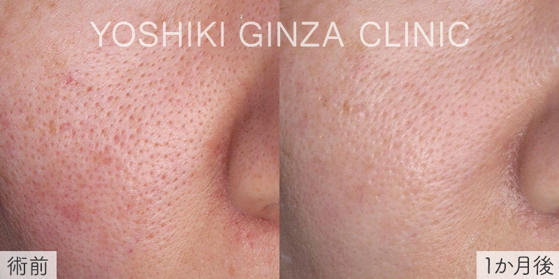 スマートサイドスクエア ほほの毛穴の症例写真