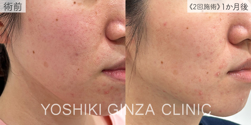 スマートサイドスクエア ほほ全体の症例写真