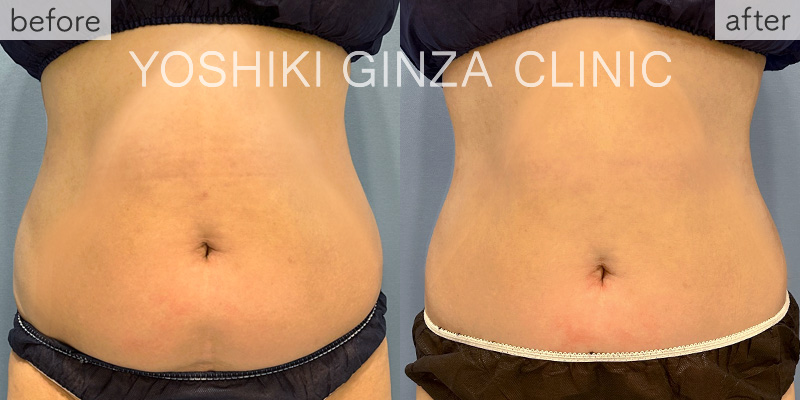 ヴァンキッシュME 腹部・背中5回の症例写真