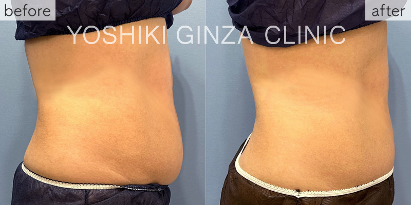 ヴァンキッシュME 腹部・背中5回の症例写真