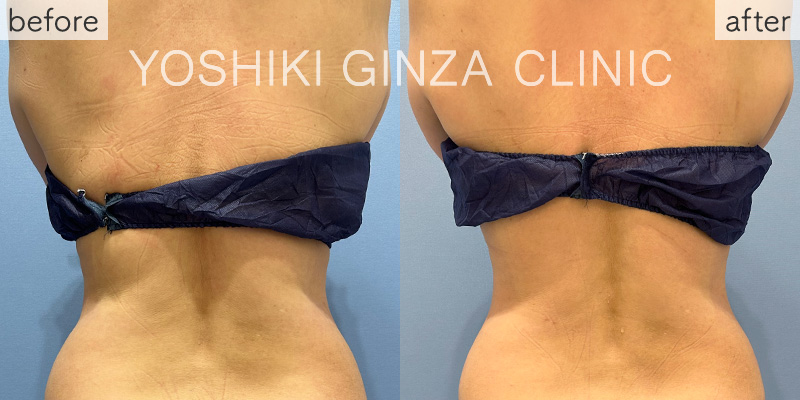 ヴァンキッシュME 腹部・背中5回の症例写真