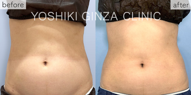 ヴァンキッシュME 腹部6回の症例写真