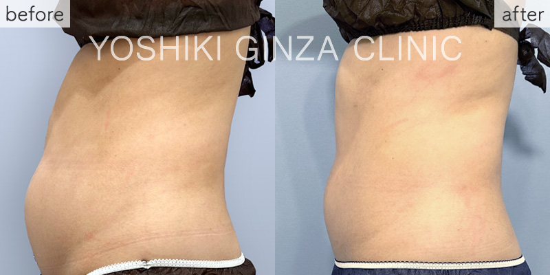 ヴァンキッシュME 腹部6回の症例写真