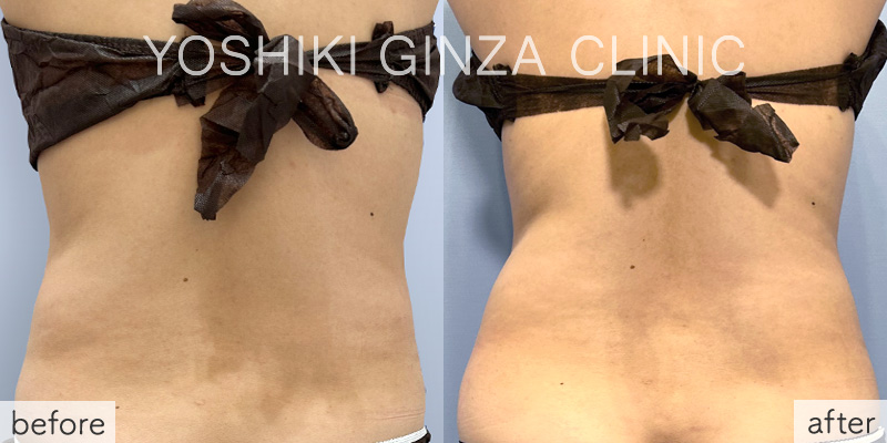 ヴァンキッシュME 腹部6回の症例写真