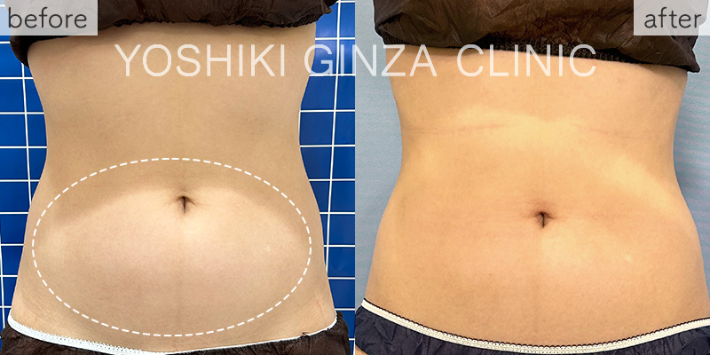 ヴァンキッシュME 腹部の症例写真