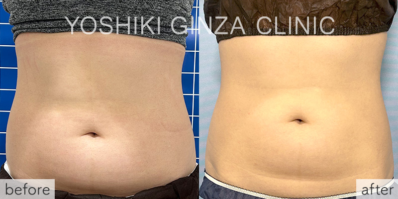 ヴァンキッシュME 腹部5回の症例写真