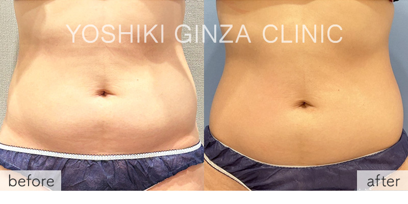 ヴァンキッシュME 腹部5回の症例写真