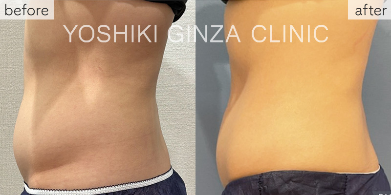 ヴァンキッシュME 腹部5回の症例写真