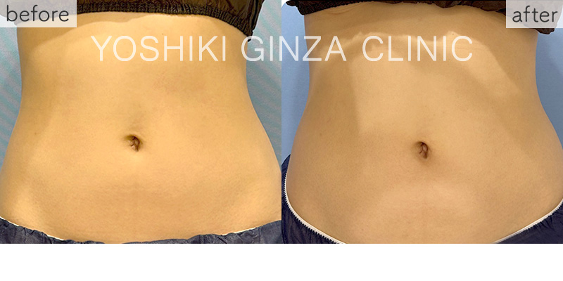 ヴァンキッシュME 腹部7回の症例写真