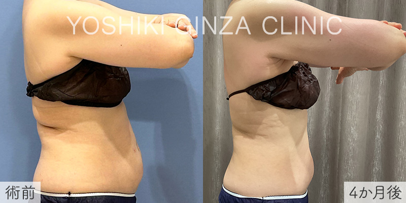 ヴァンキッシュME 下腹部6回、上腹部7回の症例写真