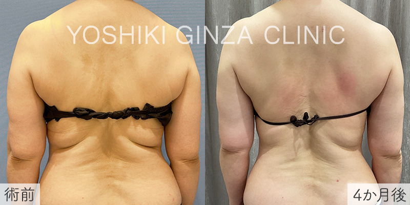 ヴァンキッシュME 背中上部12回の症例写真