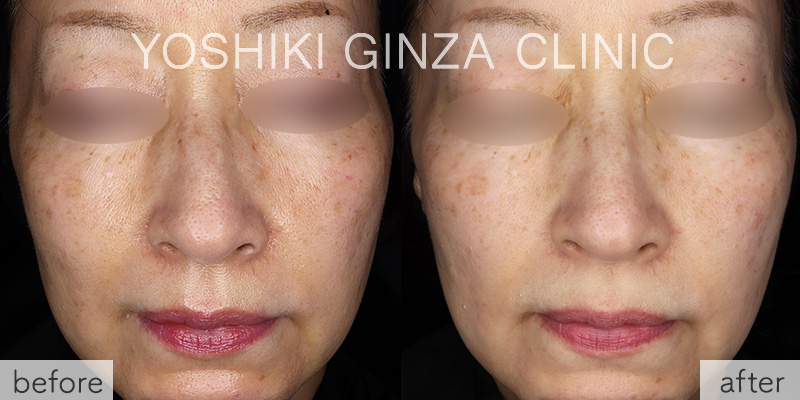 ケミカルピーリング＋ビタミンCイオン導入＋フォトフェイシャルステラの症例写真