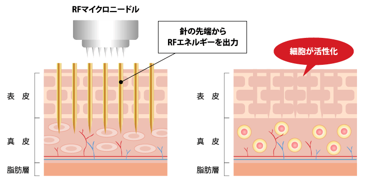 針の先端からRFエネルギーを出力し細胞を活性化