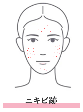 ニキビ跡