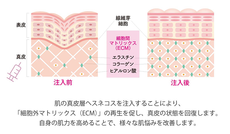 肌の真皮層へスネコスを注入することにより様々な肌悩みを改善します