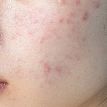 ニキビあとの赤み