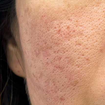 ニキビあとの陥没