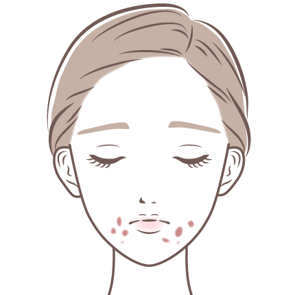 炎症性色素沈着