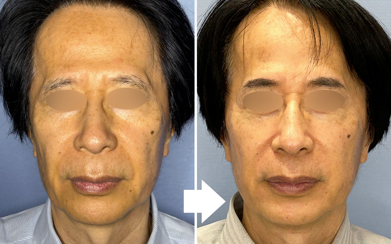真皮線維芽細胞療法で安全に自然な若さ